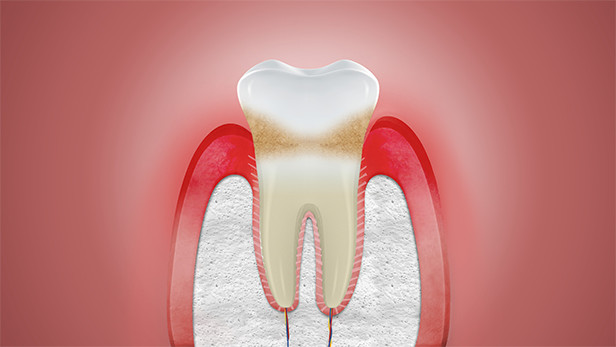 parodontax causing mouth sores